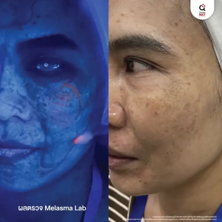 ผลการตรวจ Melasma Lab เพื่อวางแผนการรักษาปัญหาฝ้าหลังคลอด