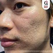 ผู้ชายที่ผิวหน้ามีปัญหา Ice Pick Scar