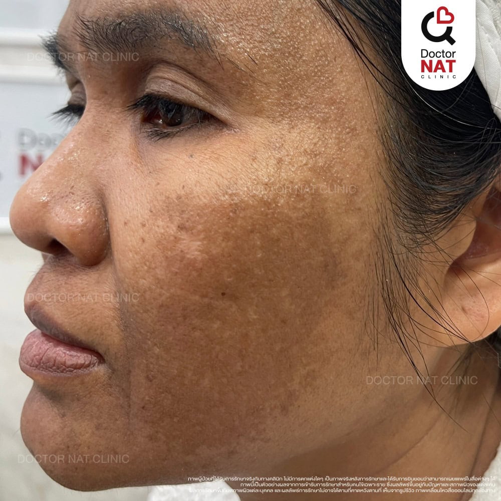 ผู้หญิงที่กำลังหาวิธีรักษาฝ้า