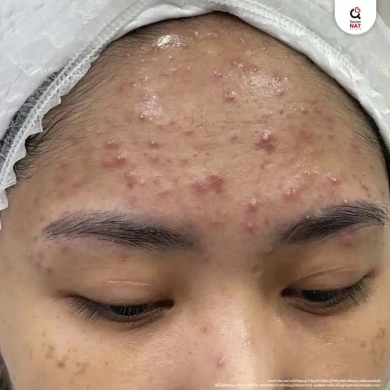 ผู้หญิงที่มีปัญหาสิวบริเวณหน้าผาก