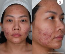 ผู้หญิงมีความกังวลเรื่องตุ่มนูนแดงบนใบหน้า
