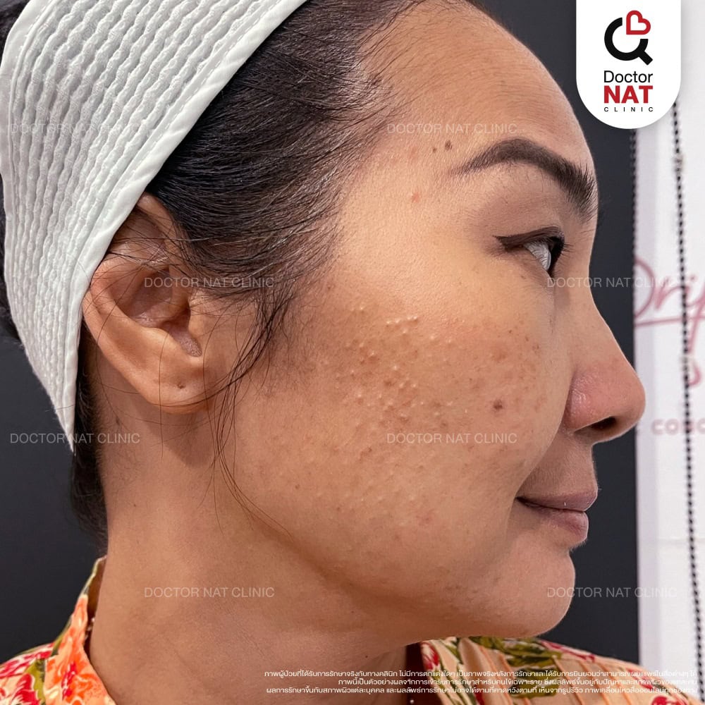 ผู้หญิงมีปัญหาสิวผู้ใหญ่