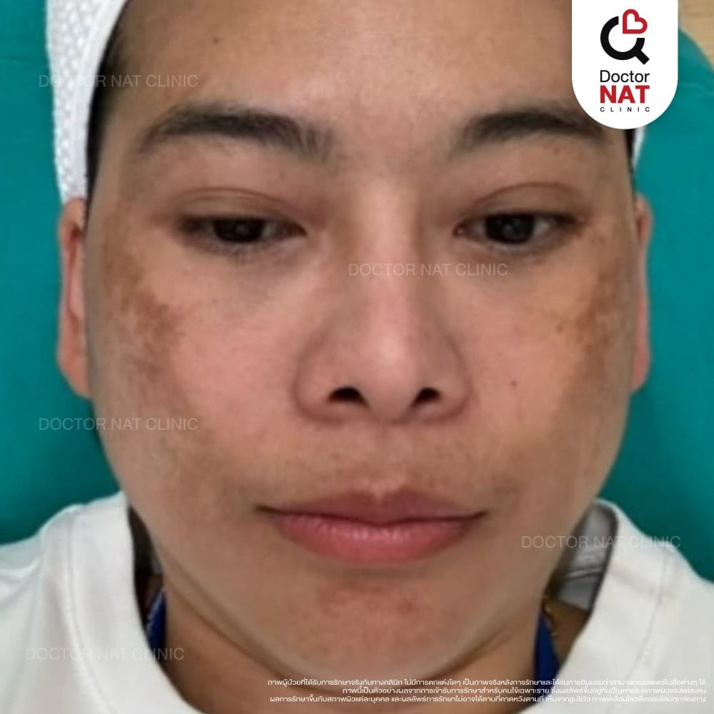 ผู้หญิงเป็นฝ้า