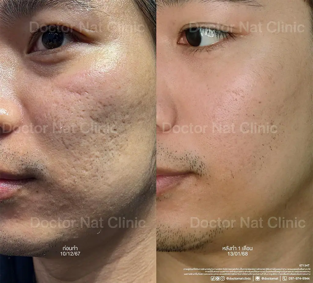 ภาพก่อนและหลังการเข้ารับโปรแกรมแก้ปัญหา Ice Pick Scar