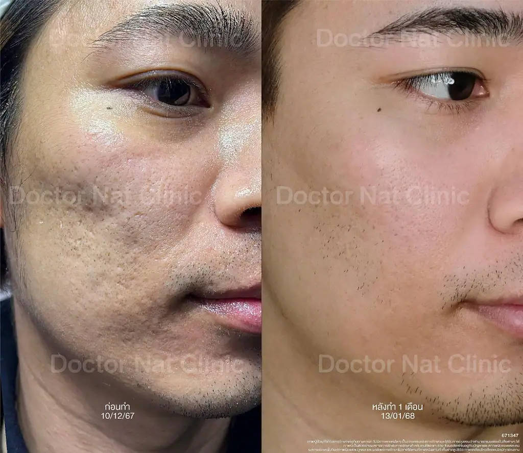 ภาพรีวิวการเข้ารับโปรแกรมแก้ปัญหา Ice Pick Scar
