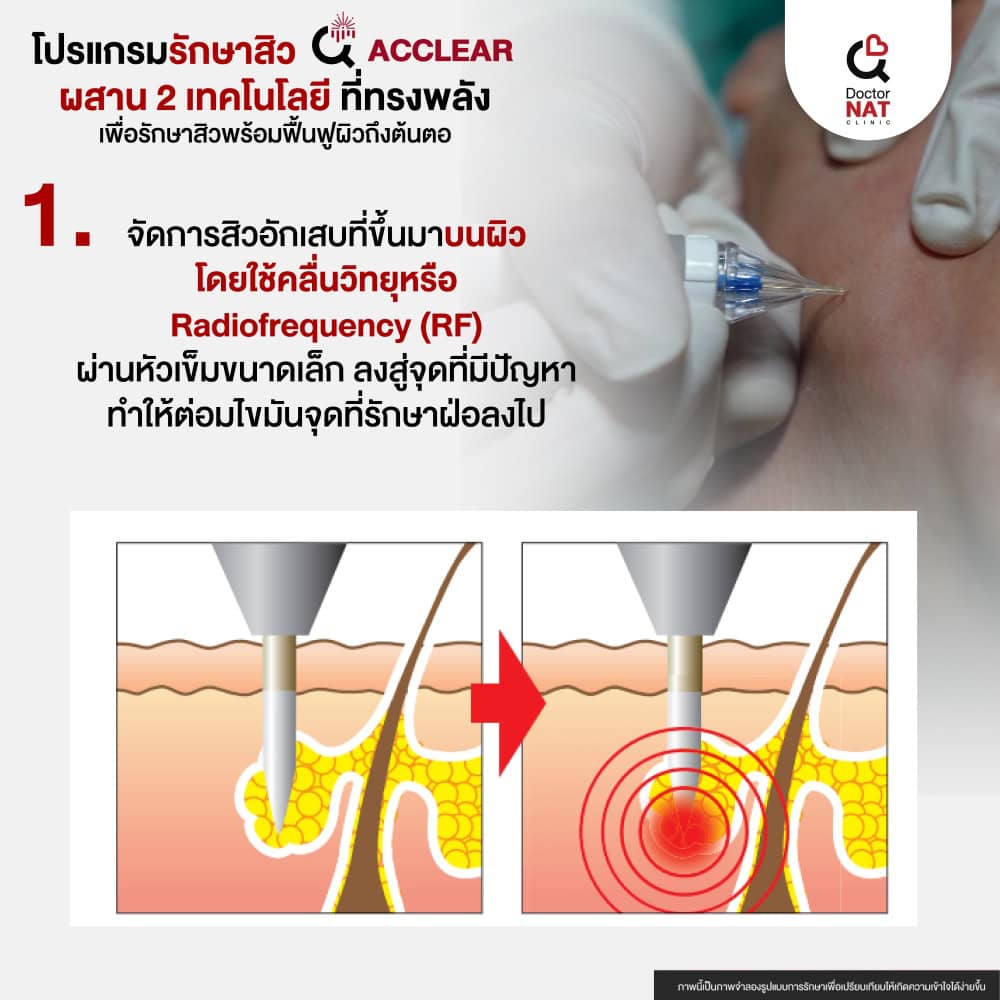 รักษาสิวที่หลัง หน้าอก และลำตัว ด้วยโปรแกรม ACCLEAR