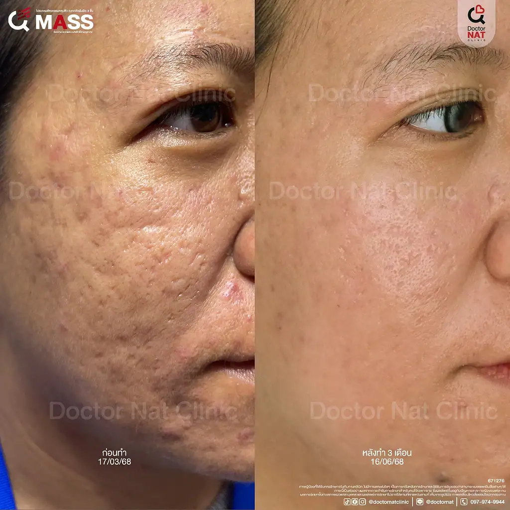 รีวิวผลลัพธ์การรักษาหลุมสิวที่ลงลึกกว่า Subcision ทั่วไป จากโปรแกรม MASS Surgery