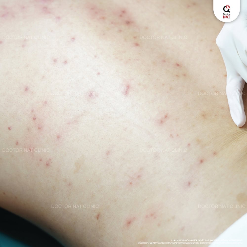 สิวขึ้นหลัง เกิดจากอะไร เข้าใจสาเหตุของสิว