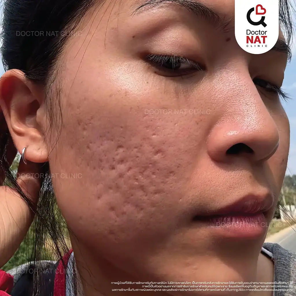 หญิงสาวประสบปัญหาหลุมสิว Boxcar scar ที่เกิดจากการเป็นสิวอักเสบรุนแรง