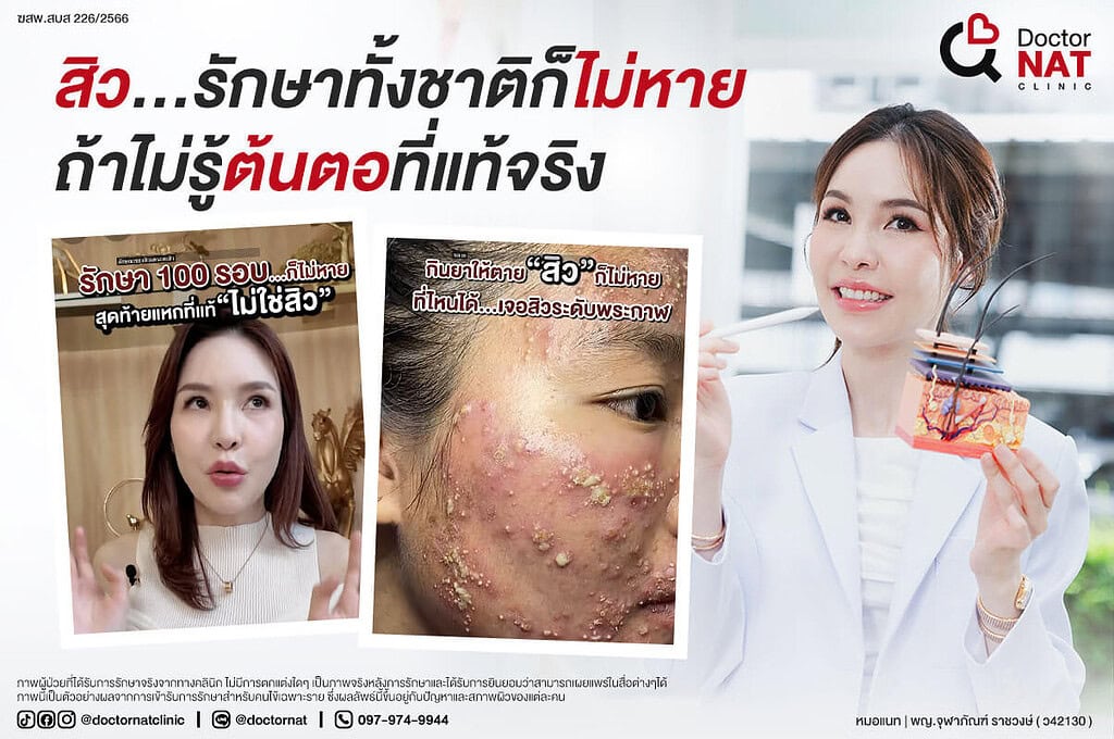 วิเคราะห์สาเหตุสิวด้วย Acne Lab | รักษาสิวตรงจุดที่ Doctor NAT
