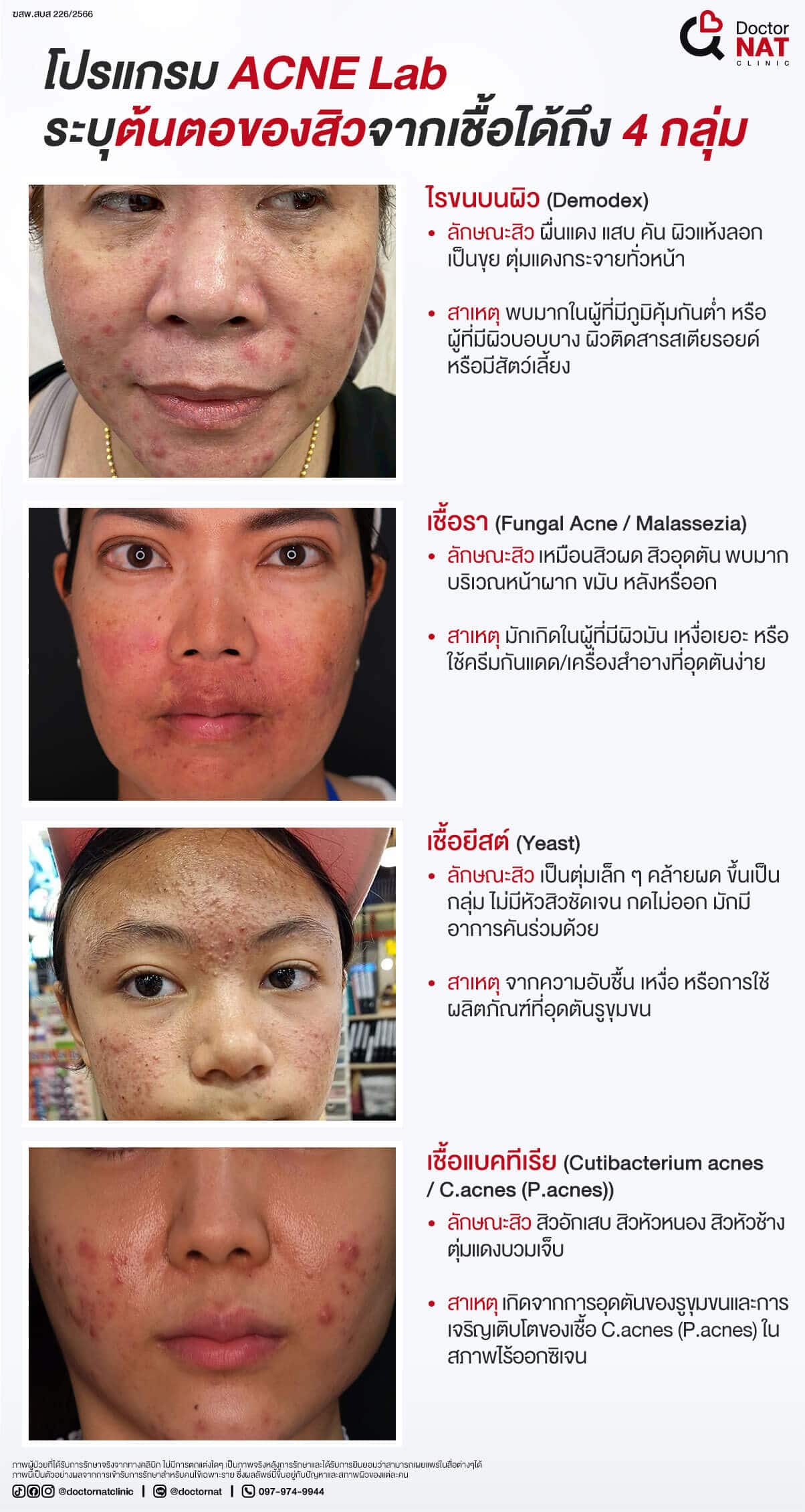 โปรแกรม ACNE Lab 
ระบุต้นตอของสิวจากเชื้อได้ถึง 4 กลุ่ม