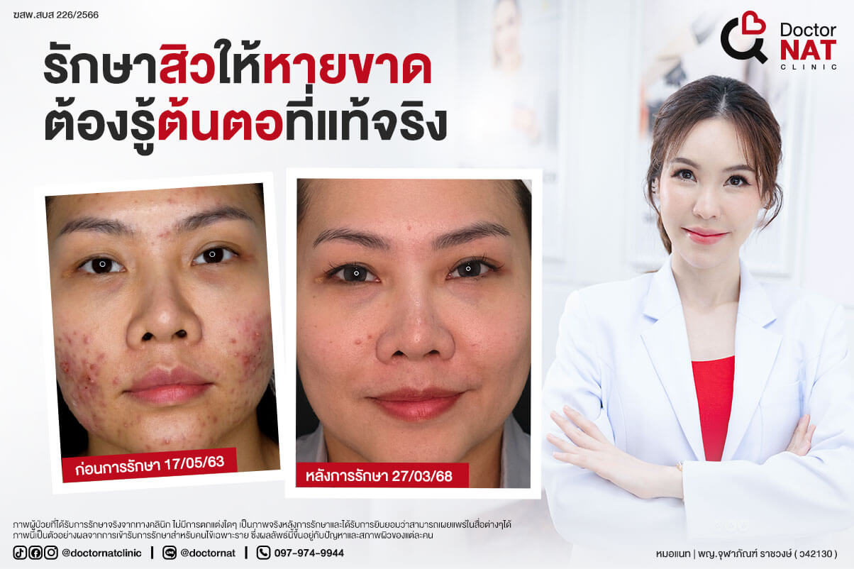 รักษาสิวให้หายขาด ต้องรู้ต้นตอของสิวที่แท้จริง Acne Lab | รักษาสิวตรงจุดที่ Doctor NAT
