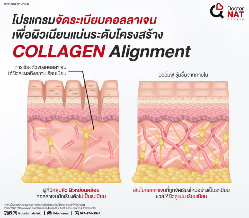 โปรแกรม Collagen Alignment คืออะไร?