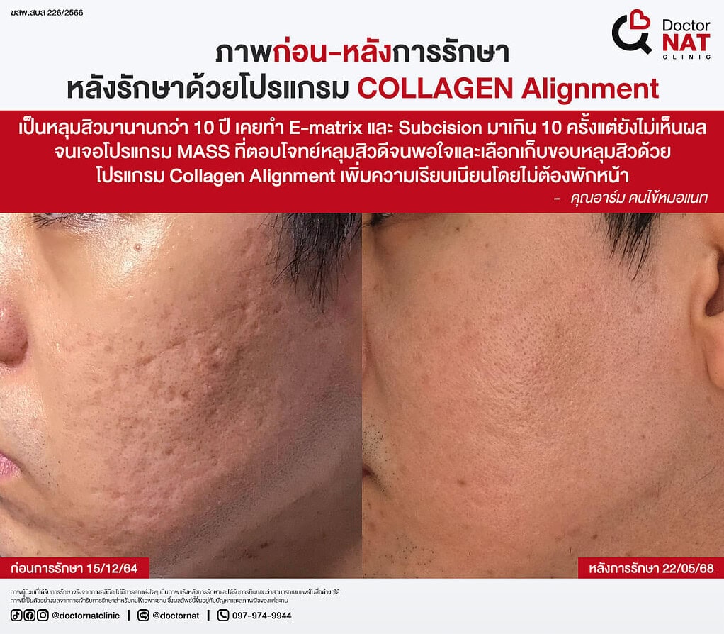 ภาพก่อน-หลังการรักษา
หลังรักษาด้วยโปรแกรม COLLAGEN Alignment