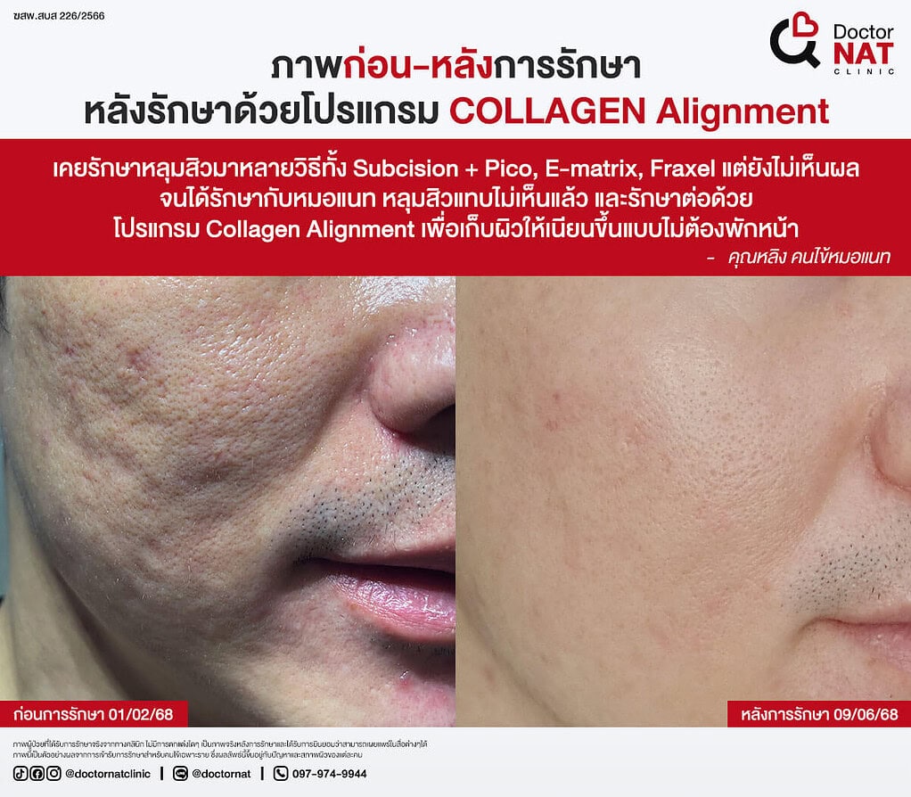 ภาพก่อน-หลังการรักษา
หลังรักษาด้วยโปรแกรม COLLAGEN Alignment