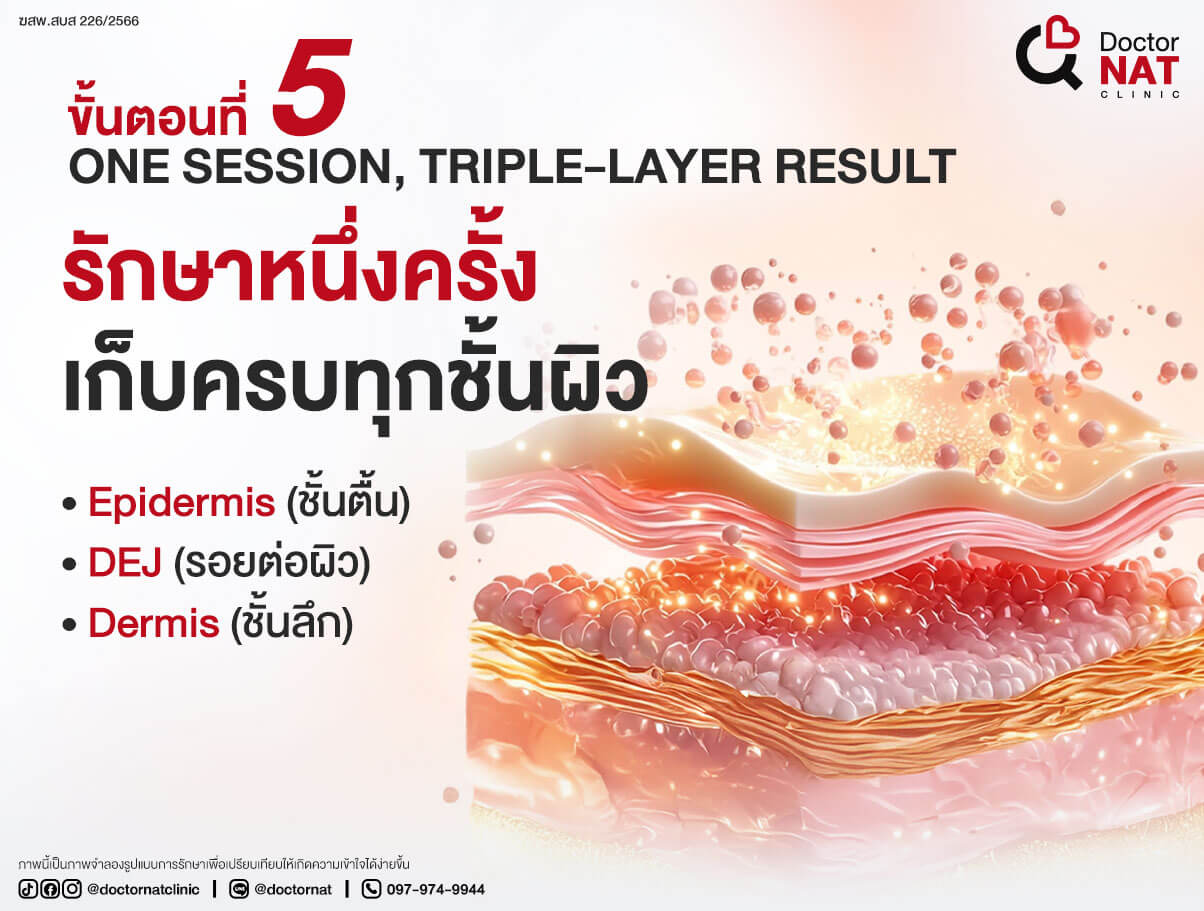 ขั้นตอนที่ 5 
One Session, Triple-Layer Result 
รักษาหนึ่งครั้ง เก็บครบทุกชั้นผิว