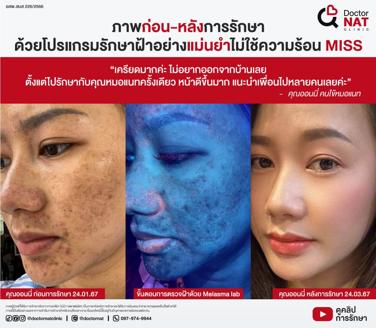 ภาพก่อน-หลังการรักษา
ด้วยโปรแกรมรักษาฝ้าอย่างแม่นยำไม่ใช้ความร้อน MISS