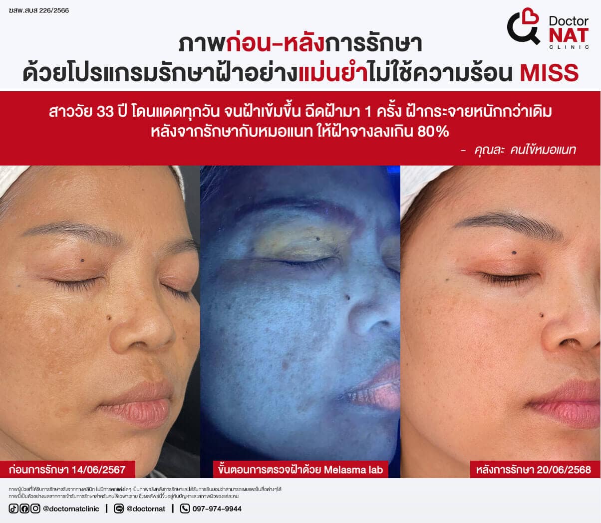 ภาพก่อน-หลังการรักษา
ด้วยโปรแกรมรักษาฝ้าอย่างแม่นยำไม่ใช้ความร้อน MISS