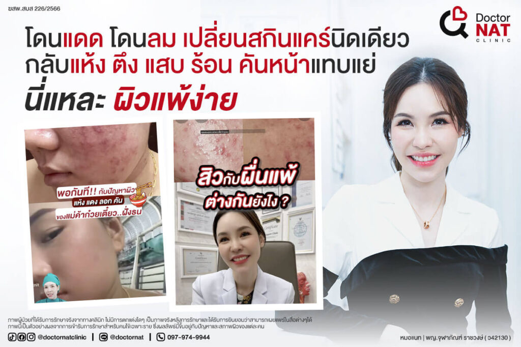 รักษาสิวผิวแพ้ง่ายลึกถึงต้นตอ | MicroKill Acne หมอแนท