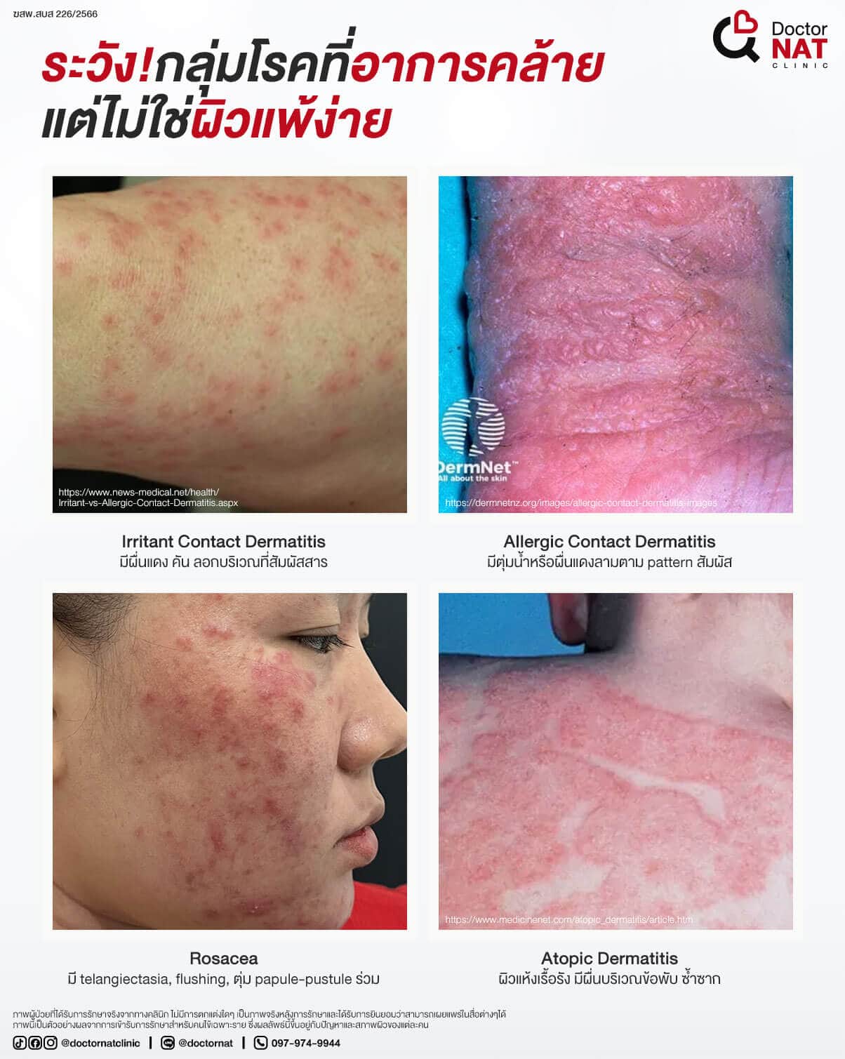 กลุ่มโรคที่อาการคล้ายผิวแพ้ง่าย  MicroKill Acne Doctor NAT Clinic