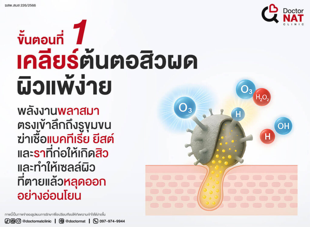 โปรแกรมฆ่าเชื้อสิวแบบไม่ทำลายผิวลงลึกถึงต้นตอ
Microkill ACNE || Doctor NAT Clinic