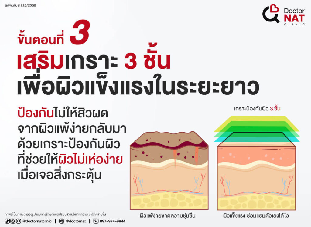 โปรแกรมฆ่าเชื้อสิวแบบไม่ทำลายผิวลงลึกถึงต้นตอ
Microkill ACNE || Doctor NAT Clinic