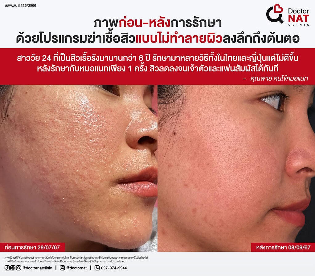 ภาพก่อน-หลังการรักษา
ด้วยโปรแกรมฆ่าเชื้อสิวแบบไม่ทำลายผิวลงลึกถึงต้นตอ