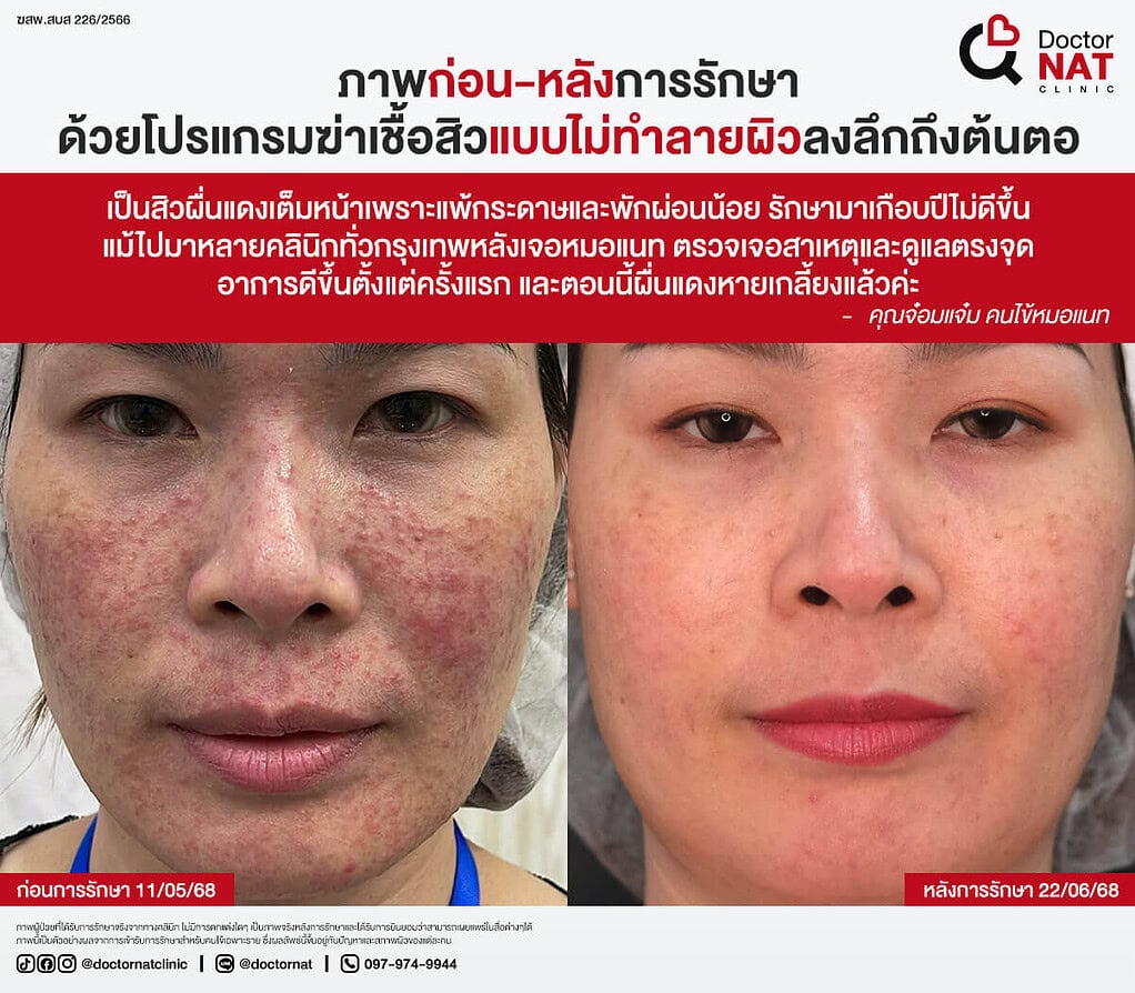 ภาพก่อน-หลังการรักษา
ด้วยโปรแกรมฆ่าเชื้อสิวแบบไม่ทำลายผิวลงลึกถึงต้นตอ