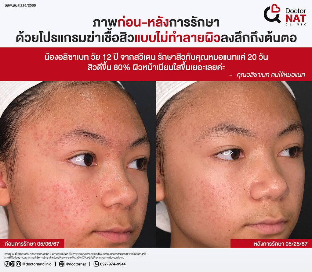 ภาพก่อน-หลังการรักษา
ด้วยโปรแกรมฆ่าเชื้อสิวแบบไม่ทำลายผิวลงลึกถึงต้นตอ