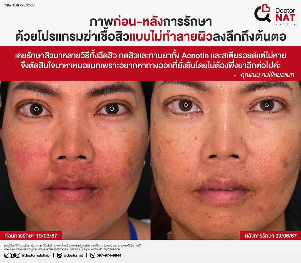 ภาพก่อน-หลังการรักษา
ด้วยโปรแกรมฆ่าเชื้อสิวแบบไม่ทำลายผิวลงลึกถึงต้นตอ