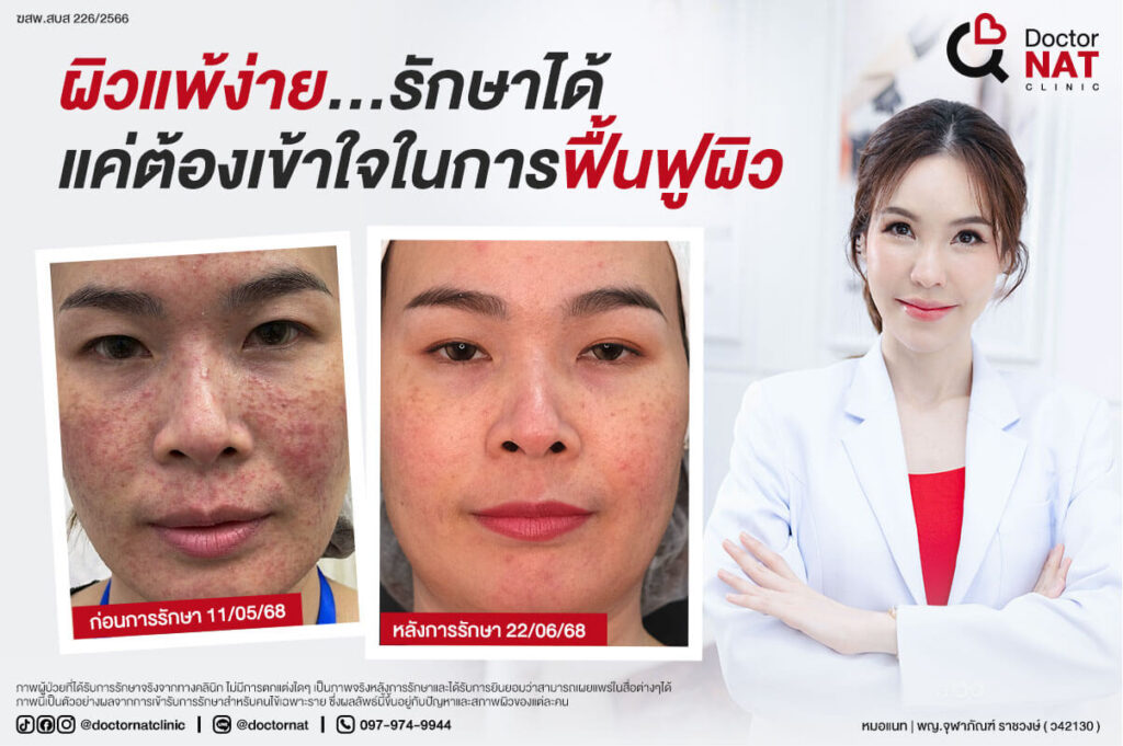 ทำไมต้องรักษาผิวแพ้ง่ายที่ Doctor NAT Clinic