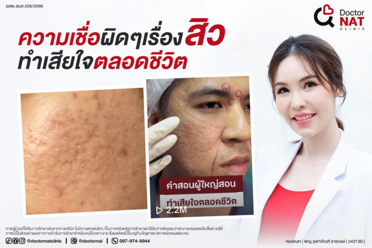 ความเชื่อผิดๆ เรื่องสิว อาจทำให้เกิดหลุมสิวถาวร | Doctor NAT Clinic