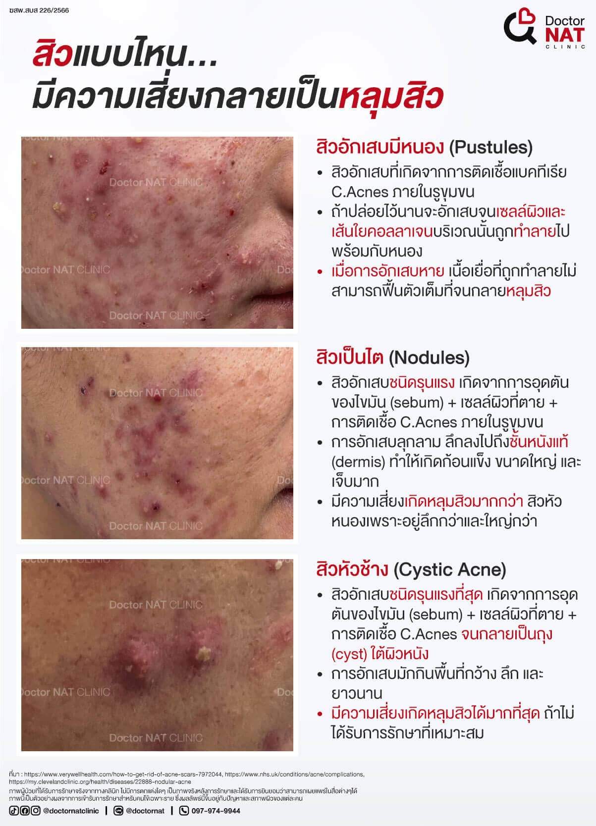 สิวแบบไหน...มีความเสี่ยงกลายเป็นหลุมสิว