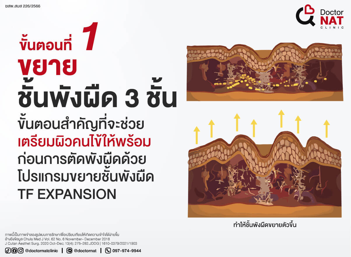 ขั้นตอนที่ 1 
ขยายชั้นพังผืด 3 ชั้น