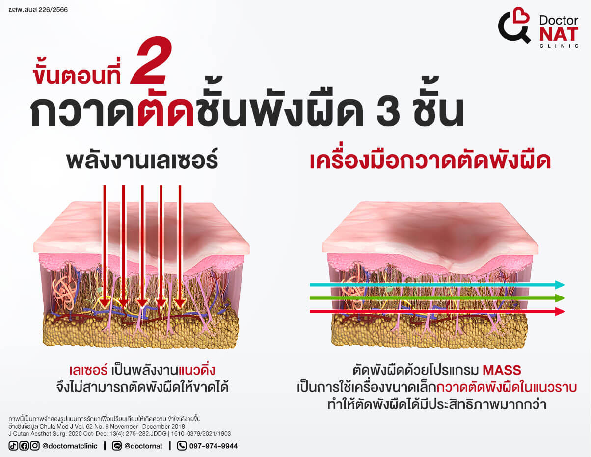 ขั้นตอนที่ 2 
กวาดตัดชั้นพังผืด 3 ชั้น