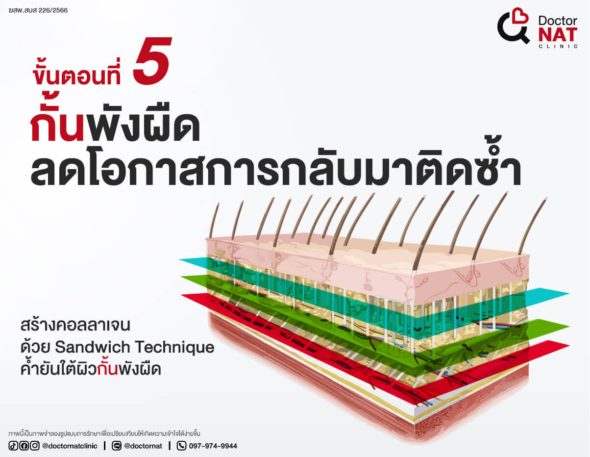 ขั้นตอนที่ 5 
กั้นพังผืดลดโอกาสการกลับมาติดซ้ำ