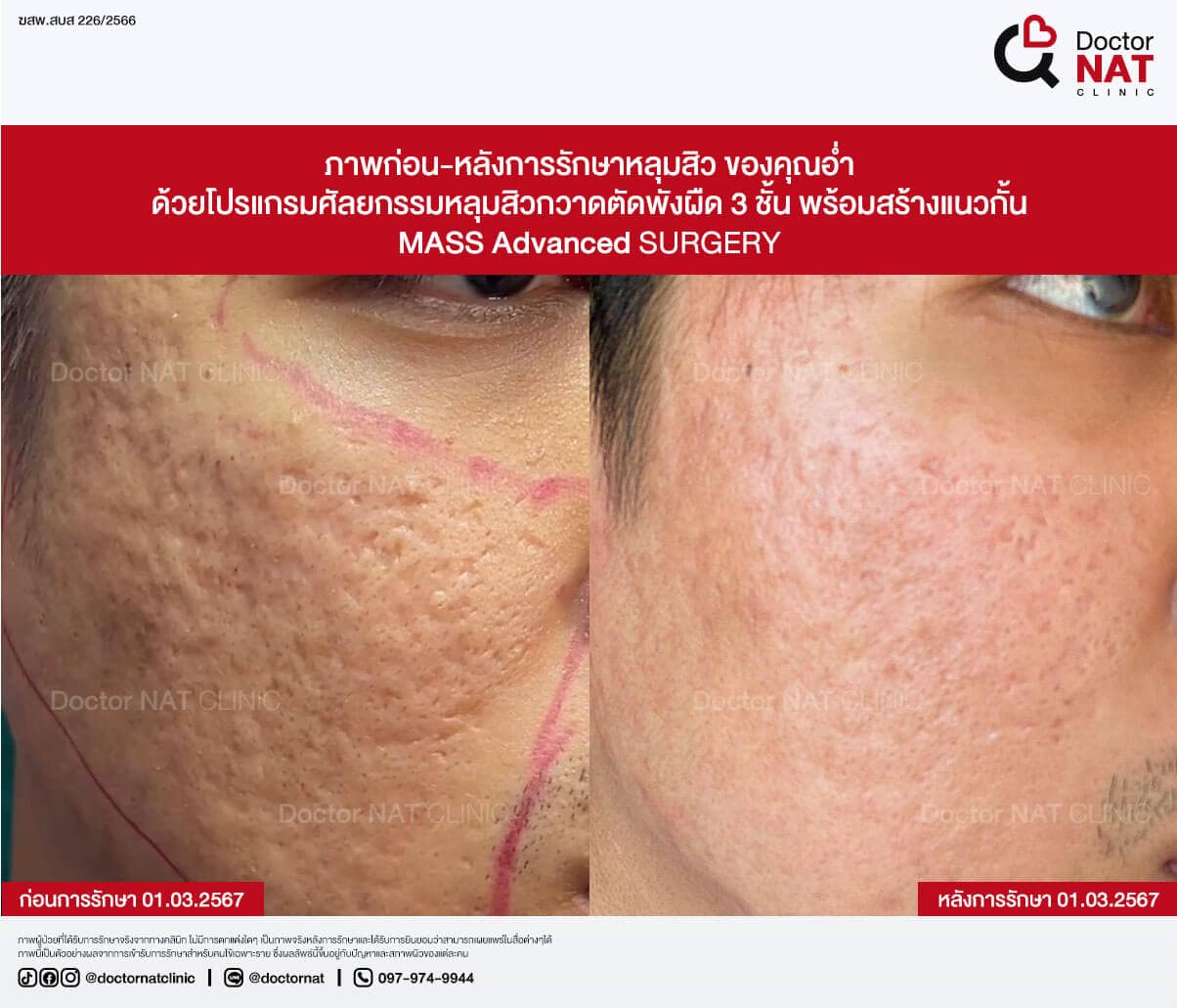 ภาพก่อน-หลังการรักษาหลุมสิว ของคุณอ่ำ
ด้วยโปรแกรมศัลยกรรมหลุมสิวกวาดตัดพังผืด 3 ชั้น พร้อมสร้างแนวกั้น
MASS Advanced Surgery