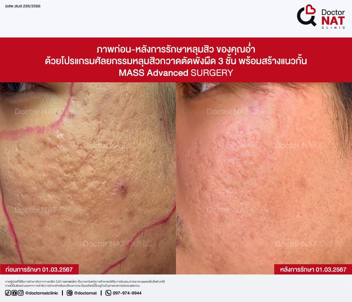 ภาพก่อน-หลังการรักษาหลุมสิว ของคุณอ่ำ
ด้วยโปรแกรมศัลยกรรมหลุมสิวกวาดตัดพังผืด 3 ชั้น พร้อมสร้างแนวกั้น
MASS Advanced Surgery
