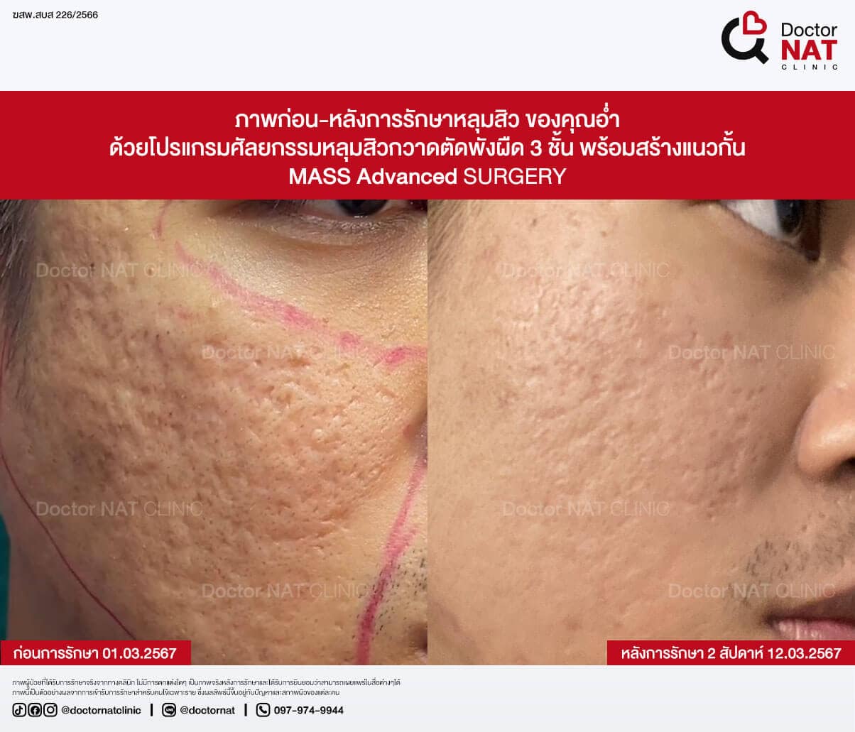 ภาพก่อน-หลังการรักษาหลุมสิว ของคุณอ่ำ
ด้วยโปรแกรมศัลยกรรมหลุมสิวกวาดตัดพังผืด 3 ชั้น พร้อมสร้างแนวกั้น
MASS Advanced Surgery