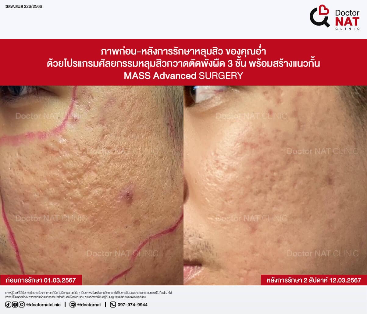 ภาพก่อน-หลังการรักษาหลุมสิว ของคุณอ่ำ
ด้วยโปรแกรมศัลยกรรมหลุมสิวกวาดตัดพังผืด 3 ชั้น พร้อมสร้างแนวกั้น
MASS Advanced Surgery