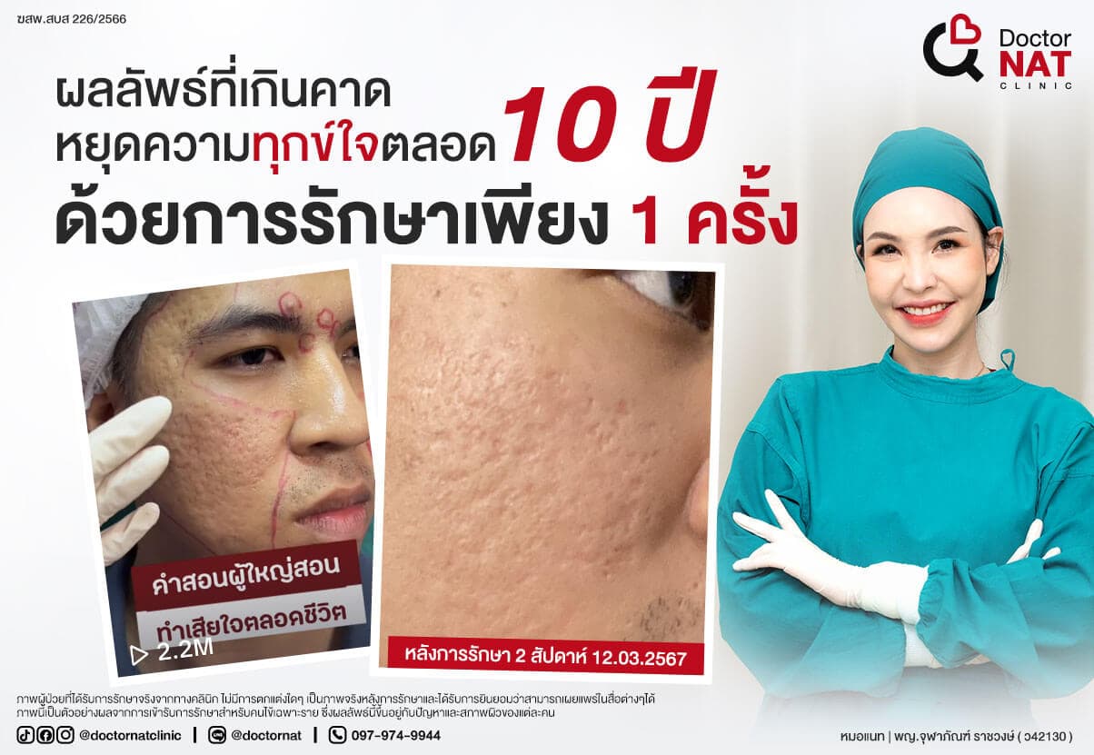 ภาพก่อน-หลังการรักษาหลุมสิว ของคุณอ่ำ
ด้วยโปรแกรมศัลยกรรมหลุมสิวกวาดตัดพังผืด 3 ชั้น พร้อมสร้างแนวกั้น
MASS Advanced Surgery