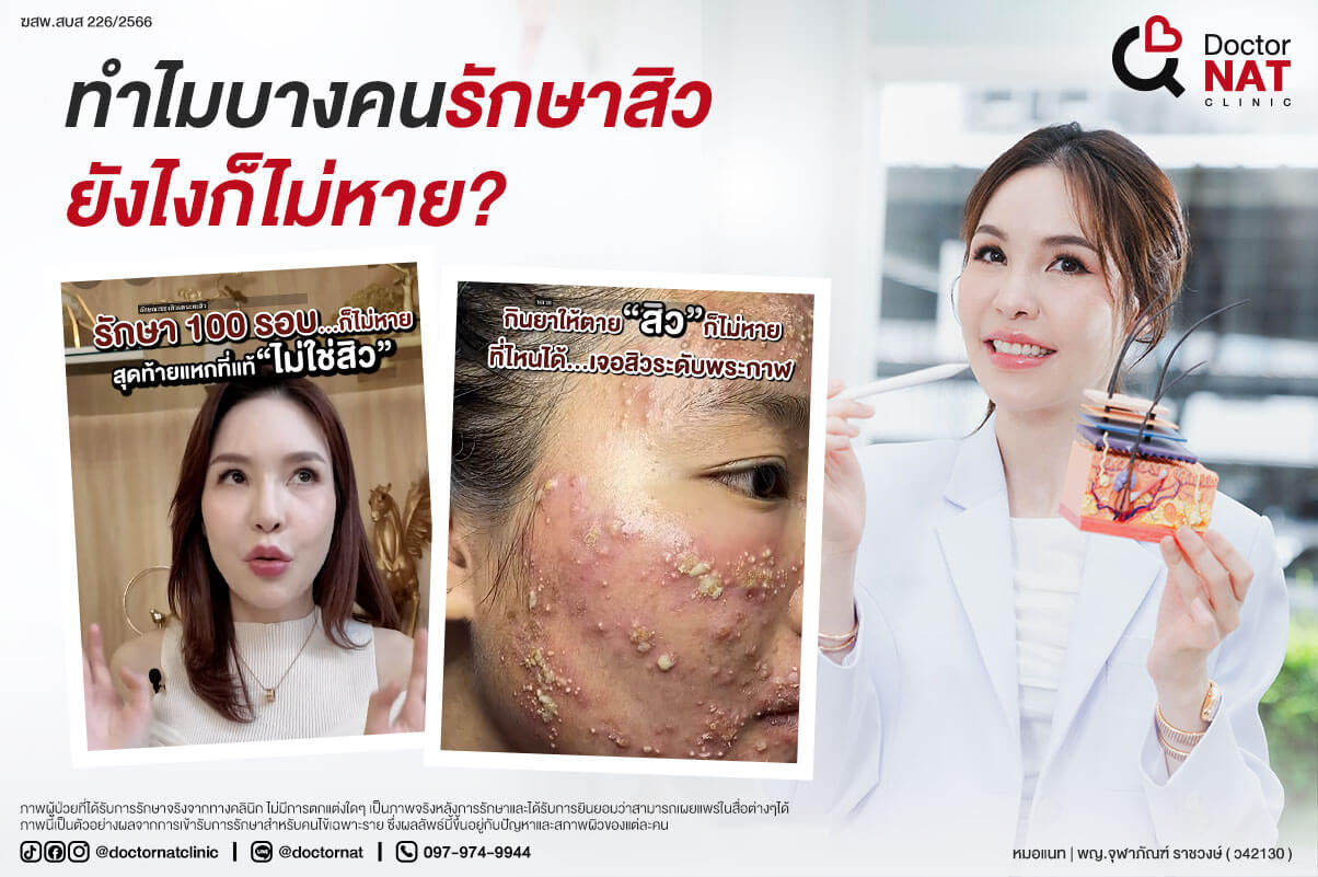 ทำไมบางคนรักษาสิวยังไงก็ไม่หาย?