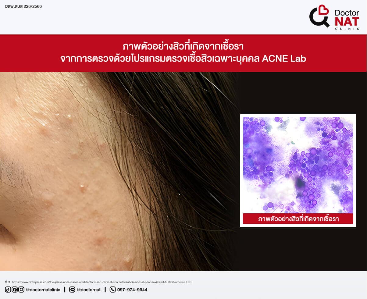 ภาพตัวอย่างสิวที่เกิดจากเชื้อรา
จากการตรวจด้วยโปรแกรมตรวจเชื้อสิวเฉพาะบุคคล ACNE Lab