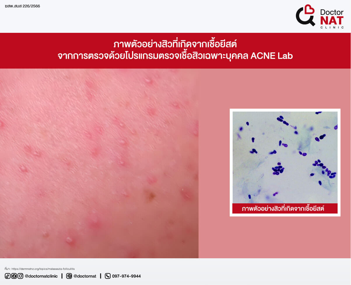 ภาพตัวอย่างสิวที่เกิดจากเชื้อยีสต์
จากการตรวจด้วยโปรแกรมตรวจเชื้อสิวเฉพาะบุคคล ACNE Lab