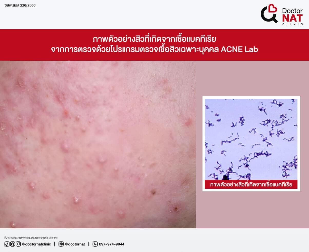 ภาพตัวอย่างสิวที่เกิดจากเชื้อแบคทีเรีย
จากการตรวจด้วยโปรแกรมตรวจเชื้อสิวเฉพาะบุคคล ACNE Lab