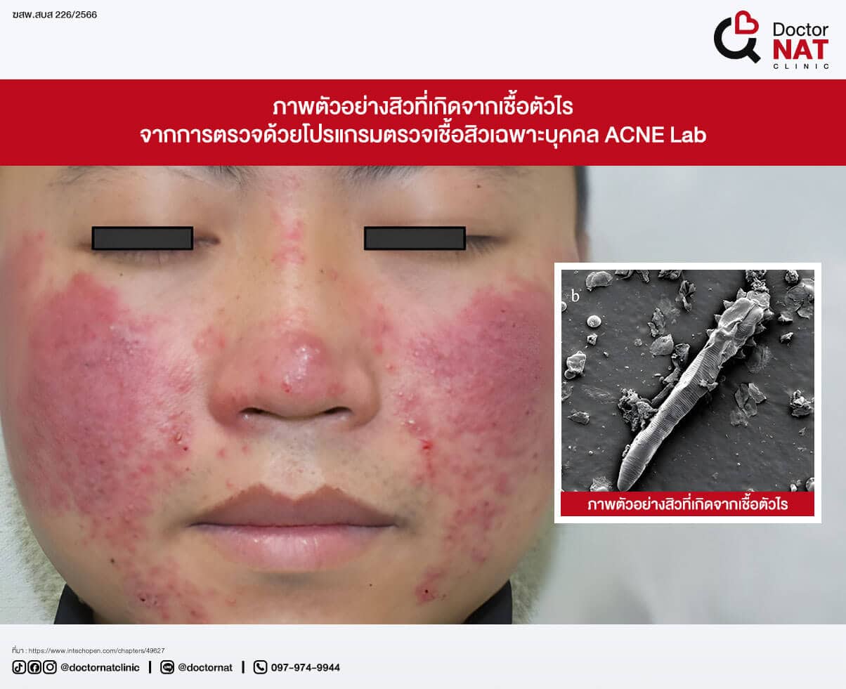 ภาพตัวอย่างสิวที่เกิดจากเชื้อแบคทีเรีย
จากการตรวจด้วยโปรแกรมตรวจเชื้อสิวเฉพาะบุคคล ACNE Lab