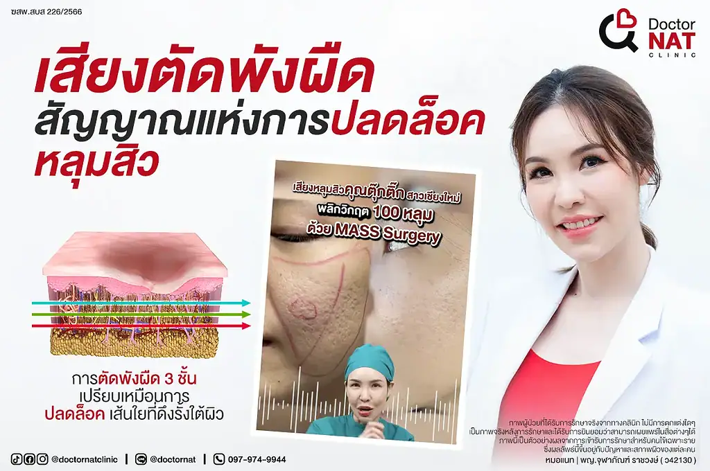 หน้าแรก 20 เสียงตัดพังผืด สัญญาณแห่งการปลดล็อคหลุมสิว Doctor NAT Clinic