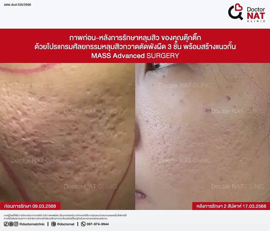 ภาพก่อน-หลังการรักษาหลุมสิว ของคุณตุ๊กติ๊ก ด้วยโปรแกรมศัลยกรรมหลุมสิวกวาดตัดพังผืด 3 ชั้น พร้อมสร้างแนวกั้น MASS Advanced Surgery