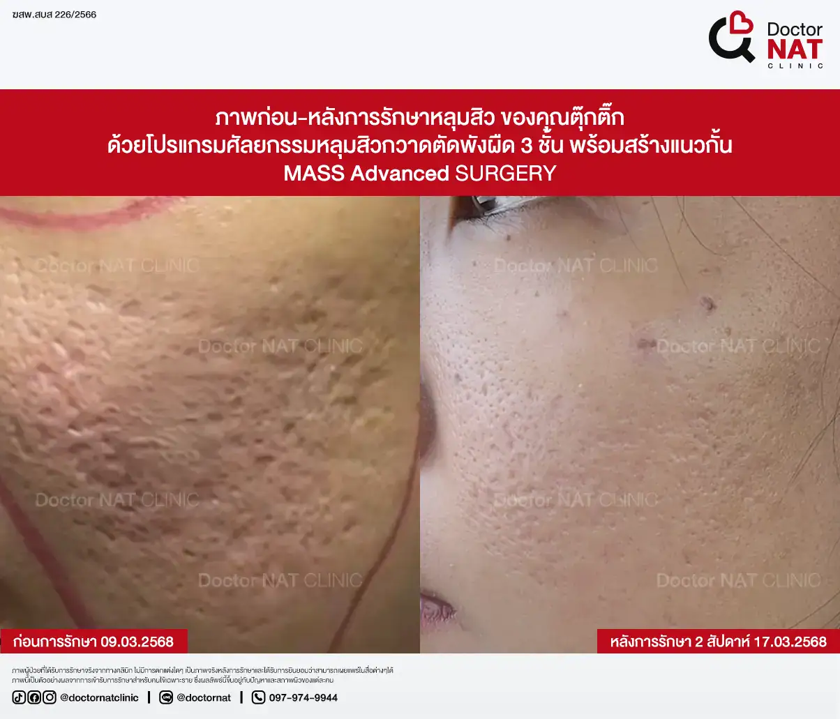 ภาพก่อน-หลังการรักษาหลุมสิว ของคุณตุ๊กติ๊ก
ด้วยโปรแกรมศัลยกรรมหลุมสิวกวาดตัดพังผืด 3 ชั้น พร้อมสร้างแนวกั้น
MASS Advanced Surgery