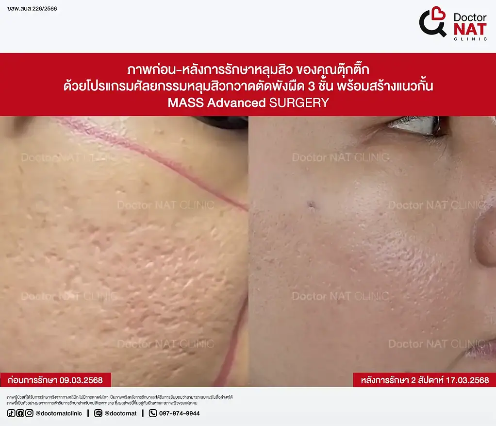 ภาพก่อน-หลังการรักษาหลุมสิว ของคุณตุ๊กติ๊ก ด้วยโปรแกรมศัลยกรรมหลุมสิวกวาดตัดพังผืด 3 ชั้น พร้อมสร้างแนวกั้น MASS Advanced Surgery